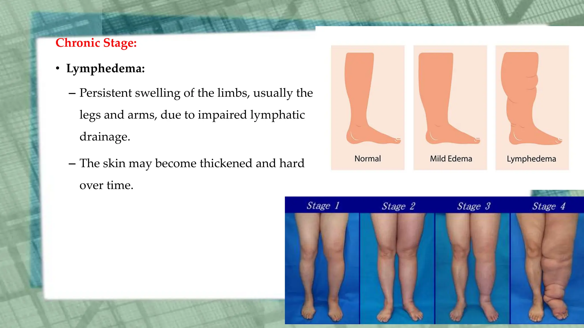 Chronic Stage:
• Lymphedema:
– Persistent swelling of the limbs, usually the
legs and arms, due to impaired lymphatic
drainage.
– The skin may become thickened and hard
over time.
