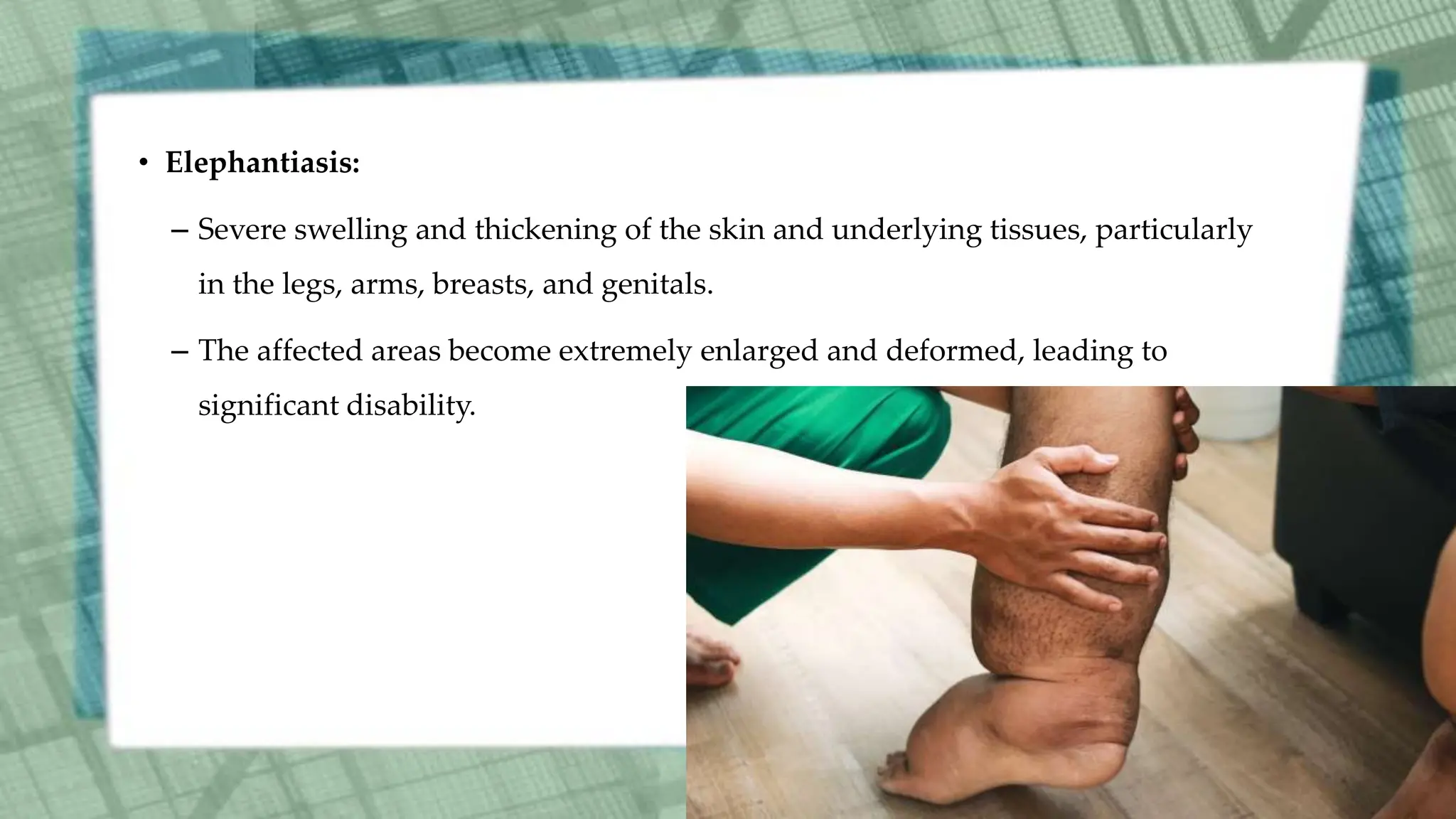 • Elephantiasis:
– Severe swelling and thickening of the skin and underlying tissues, particularly
in the legs, arms, breasts, and genitals.
– The affected areas become extremely enlarged and deformed, leading to
significant disability.