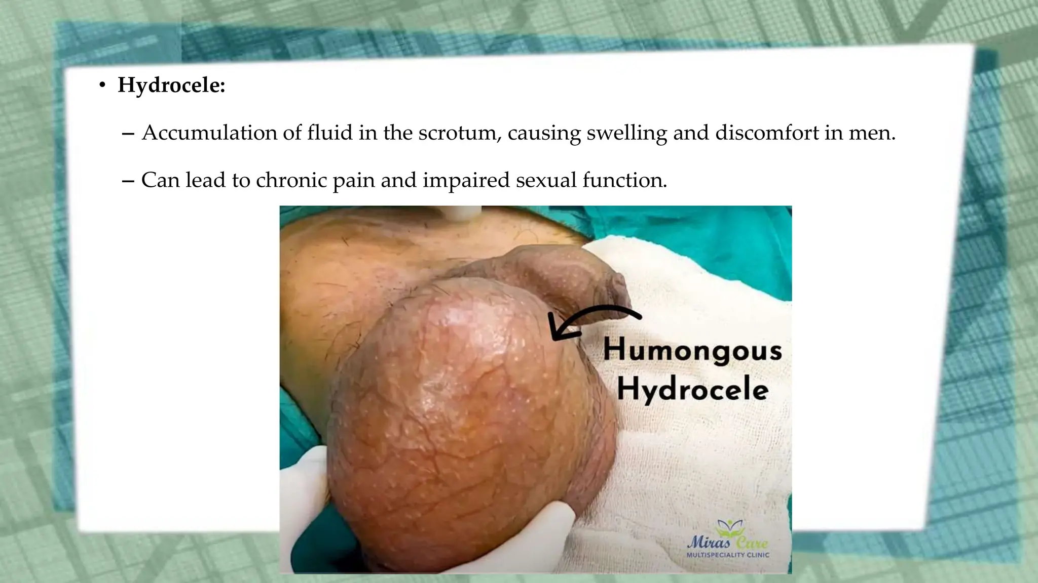 • Hydrocele:
– Accumulation of fluid in the scrotum, causing swelling and discomfort in men.
– Can lead to chronic pain and impaired sexual function.