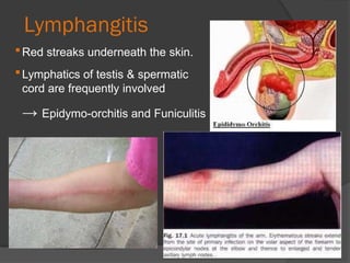 Funicularitis Filariasis - Surgical menifaststaions and | PPTX