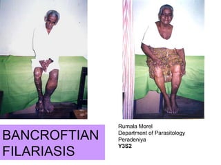 BANCROFTIAN
FILARIASIS
Rumala Morel
Department of Parasitology
Peradeniya
Y3S2
 