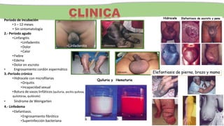 Período de incubación
•3 – 12 meses
• Sin sintomatología
2.- Período agudo
•Linfangitis
•Linfadenitis
•Dolor
•Calor
•Fiebre
•Edema
•Dolor en escroto
• Engrosamiento cordón espermático
3.-Período crónico
•Hidrocele con microfilarias
•Orquitis
•Incapacidad sexual
•Rotura de vasos linfáticos (quiluria, ascitis quilosa,
quilotórax, quilócele)
• Síndrome de Weingarten
4.- Linfedema
•Elefantiasis.
•Engrosamiento fibrótico
•Superinfección bacteriana
Hidrocele:
CLINICA
Elefantiasis:
•Linfadenitis
 
