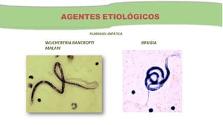 AGENTES ETIOLÓGICOS
FILARIASIS LINFÁTICA
WUCHERERIABANCROFTI BRUGIA
MALAYI
 