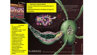 A. RESPUESTA AGUDA INICIAL
Reacción inflamatoria local especifica para el
parasito.
Infiltrado inflamatorio alrededor del lugar de
inoculación
1. El mosquito
infectado libera la
microfilaria
2.Microfilaria migra a través
de capilares y vasos
linfáticos
3.Maduración de la larva
hacia su forma adulta(3 a
12 meses en la circulación)
4.Dilatación de vasos
5.Poliposis intramural
6.Hipertrofia de las
paredes de los vasos
7.Fibrosis de las paredes
de los vasos por la
repuesta inflamatoria
granulomatosa
8.Bloqueo de vasos linfáticos
9.Crecimiento del nódulo
linfático
 
