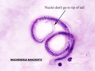 WUCHERERIA BANCROFTI
 