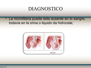 DIAGNOSTICO
• La microfilaria puede esta ausente en lo sangre,
  todavia en la orina o liquido da hidrocele;
 