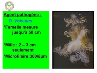 Agent pathogène :
  O. Volvulus
*Femelle mesure 
   jusqu’à 50 cm

*Mâle : 2 – 3 cm  
    seulement
*Microfilaire:300/8µm
 