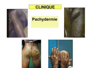 CLINIQUE


Pachydermie
 