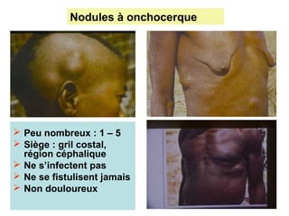 Nodules à onchocerque 




 Peu nombreux : 1 – 5
 Siège : gril costal, 
  région céphalique
 Ne s’infectent pas 
 Ne se fistulisent jamais
 Non douloureux 
 