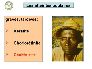 Les atteintes oculaires


graves, tardives: 
 
 Kératite

   Choriorétinite

   Cécité: +++
 