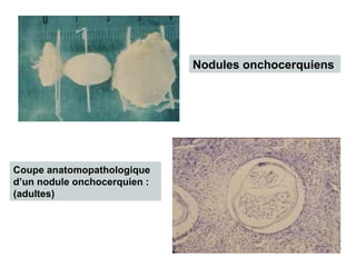 Nodules onchocerquiens




Coupe anatomopathologique 
d’un nodule onchocerquien : 
(adultes)
 