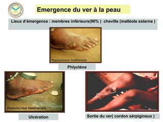 Emergence du ver à la peau
Lieux d’émergence : membres inférieurs(90% ) cheville (malléole externe )




                            Phlyctène




        Ulcération                      Sortie du ver( cordon sérpigineux )
 