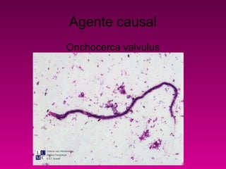 Agente causal
Onchocerca valvulus
 