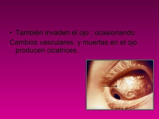 • También invaden el ojo , ocasionando
Cambios vasculares, y muertas en el ojo
producen cicatrices.
 
