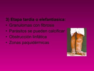 3) Etapa tardía o elefantiasica:
• Granulomas con fibrosis
• Parásitos se pueden calcificar
• Obstrucción linfática
• Zonas paquidérmicas
 