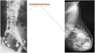Calcified Filarial Worm
 