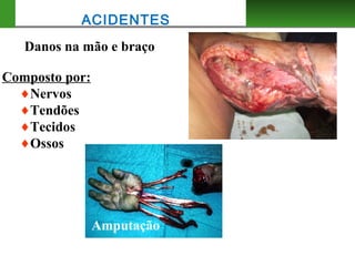 Composto por:
♦Nervos
♦Tendões
♦Tecidos
♦Ossos
Amputação
Danos na mão e braço
ACIDENTES
 