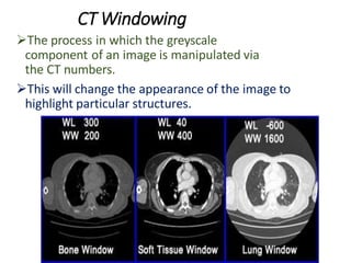 Window Ring Ct Computed tomography presentation radio physics | PDF
