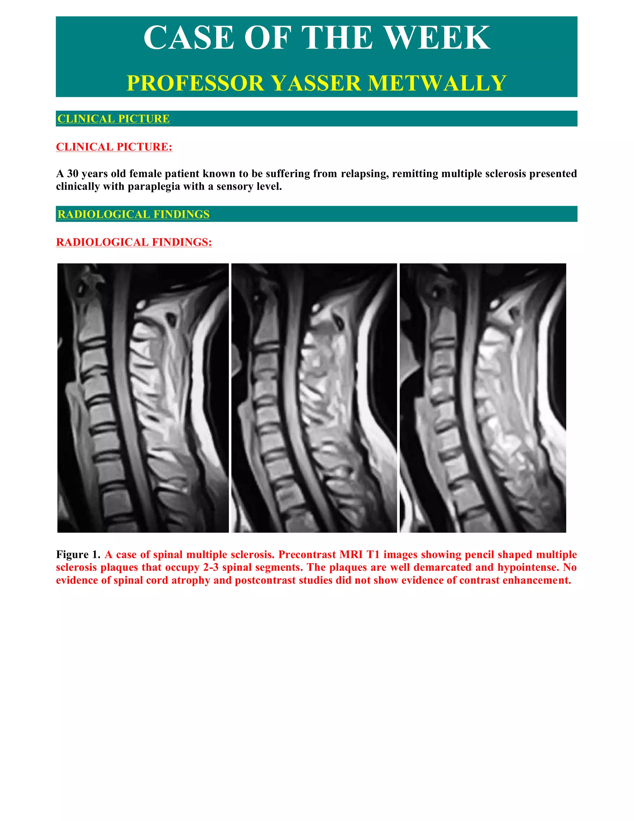 Case record...Spinal multiple sclerosis