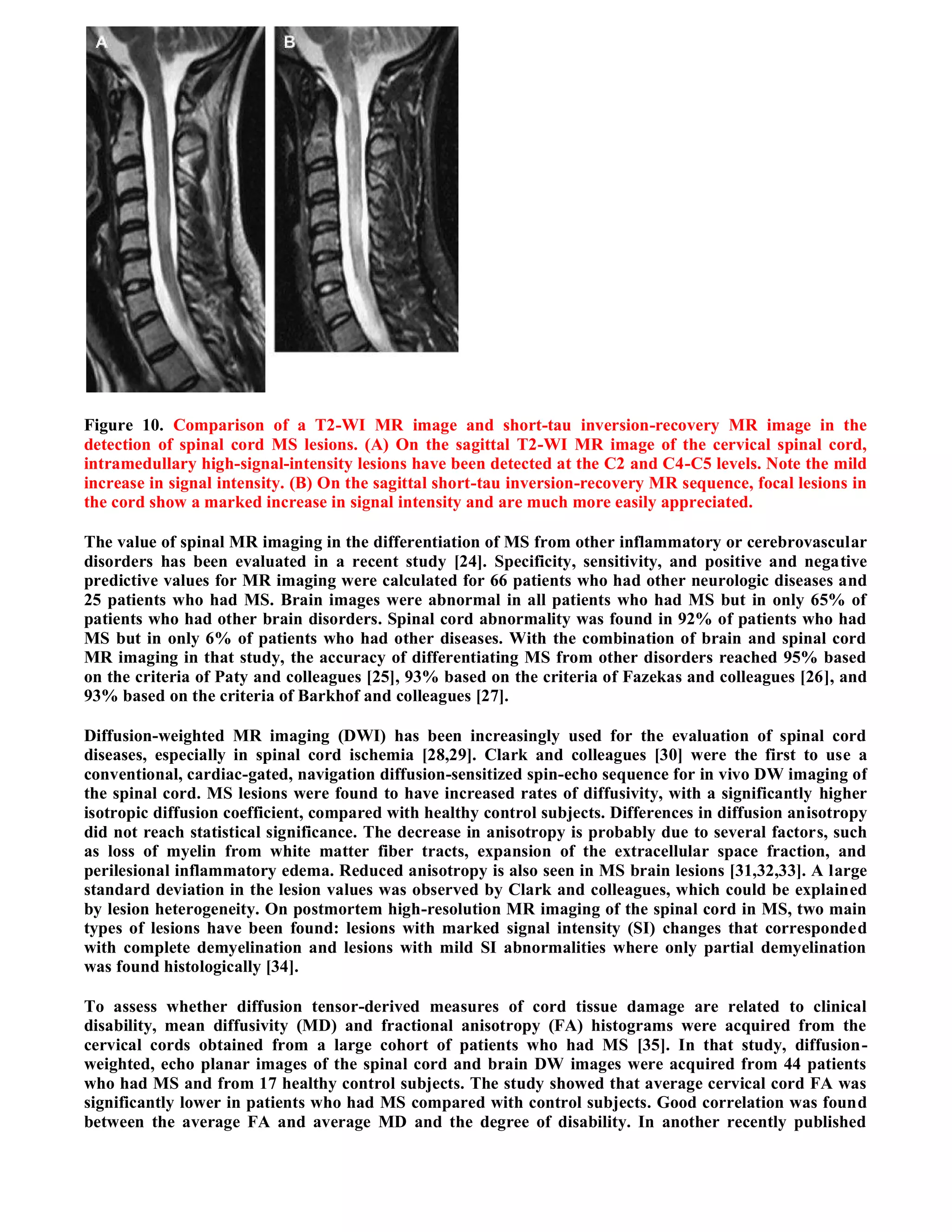 Case record...Spinal multiple sclerosis