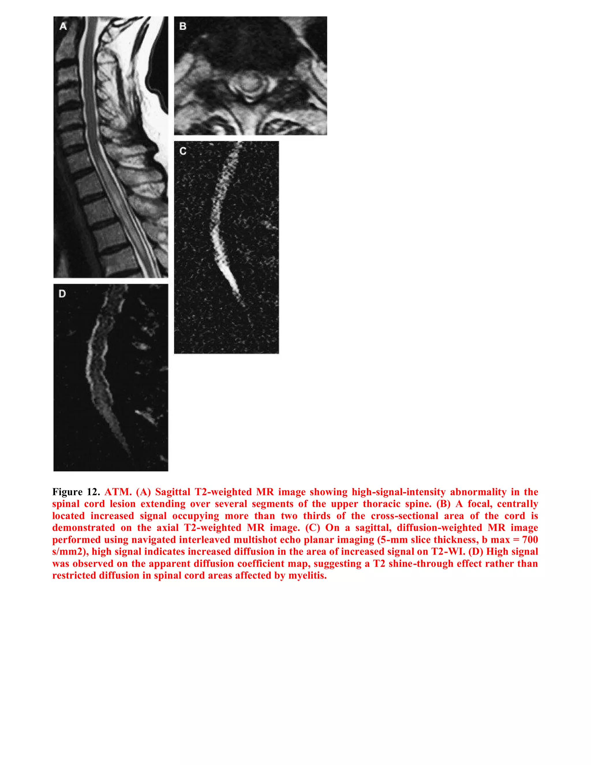 Case record...Spinal multiple sclerosis
