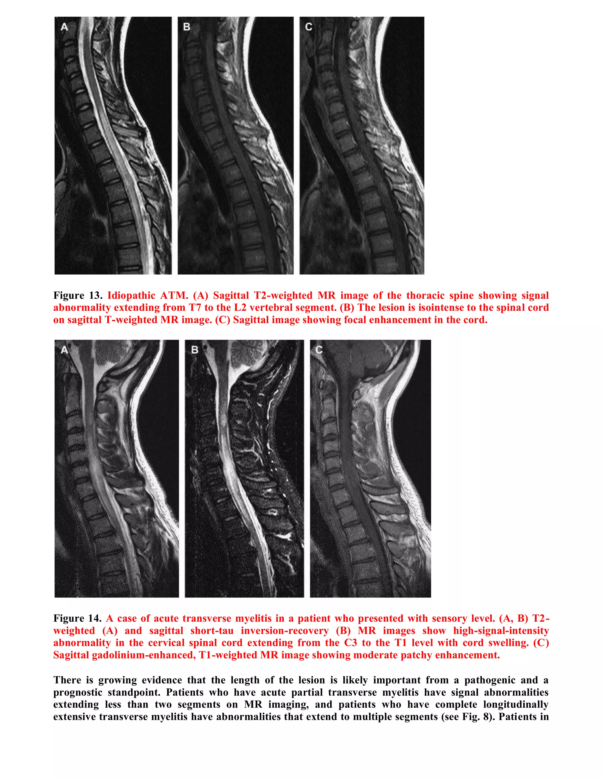 Case record...Spinal multiple sclerosis