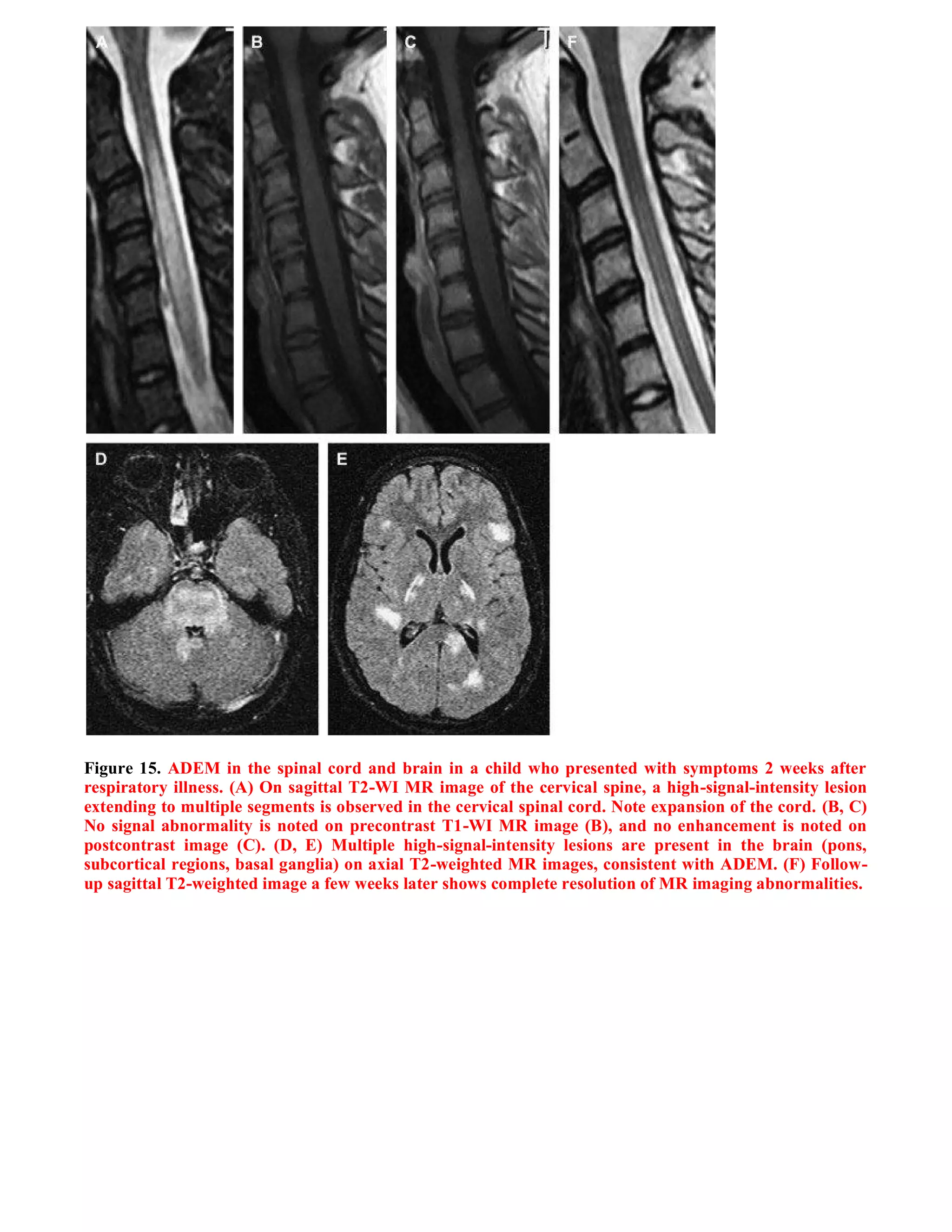 Case record...Spinal multiple sclerosis
