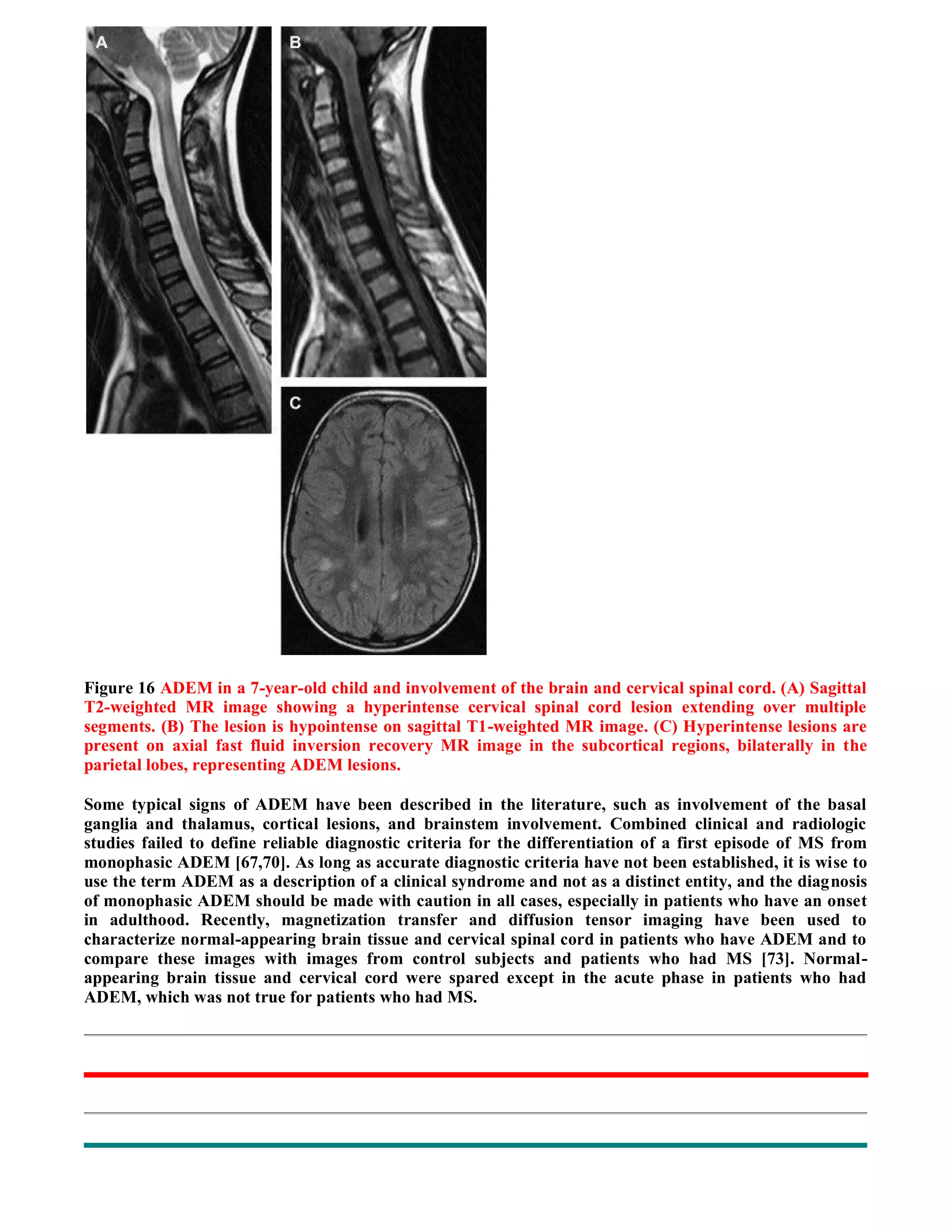 Case record...Spinal multiple sclerosis