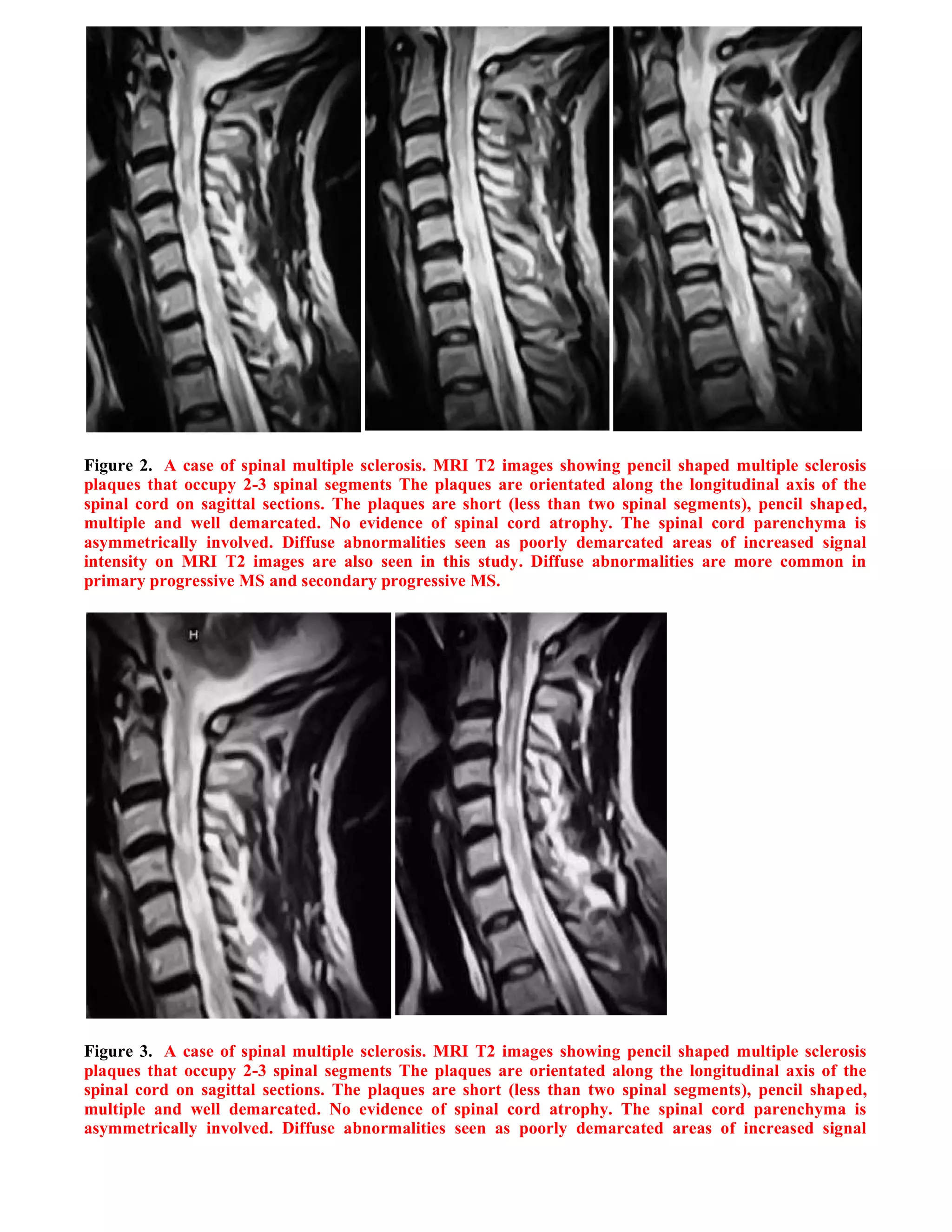 Case record...Spinal multiple sclerosis
