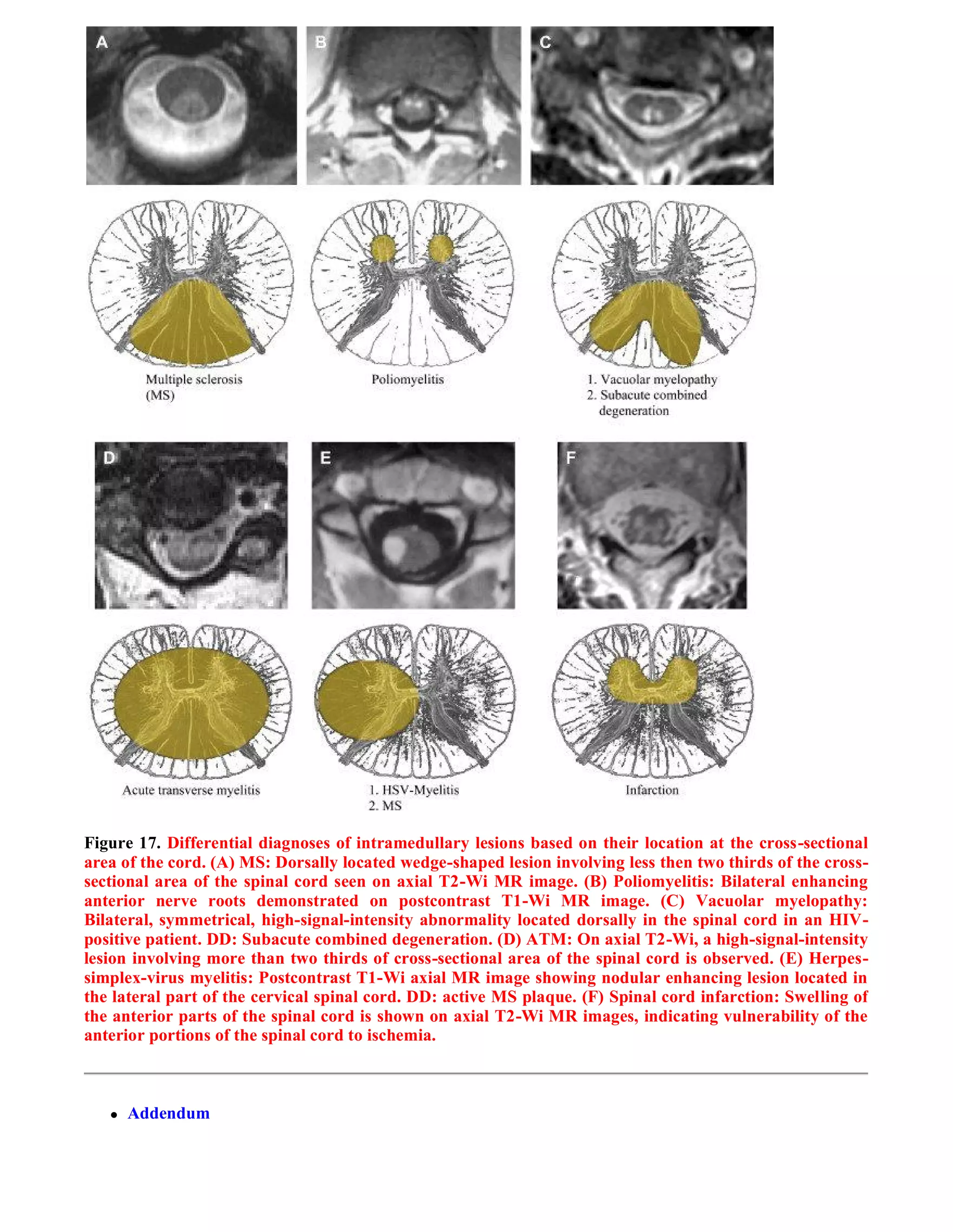 Case record...Spinal multiple sclerosis