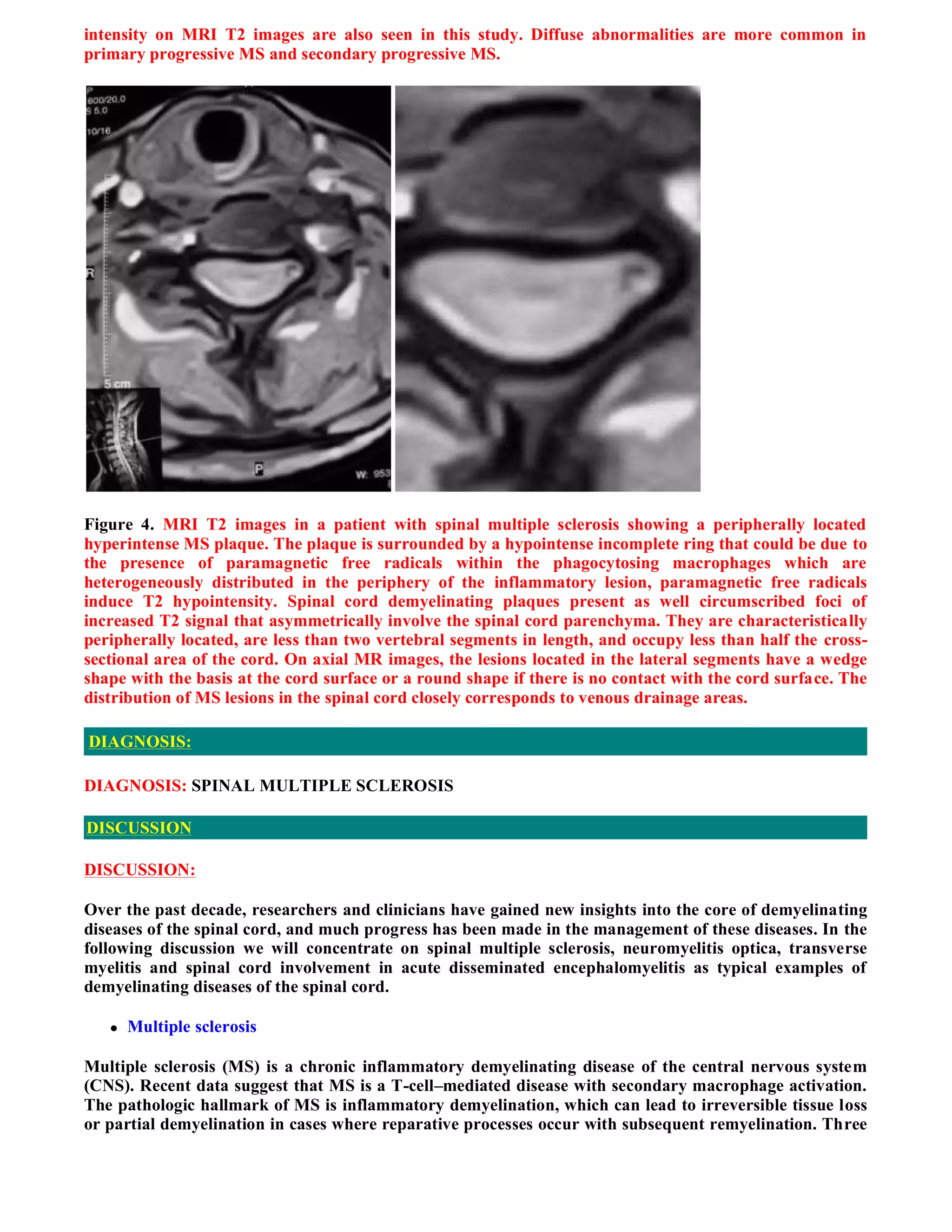 Case record...Spinal multiple sclerosis