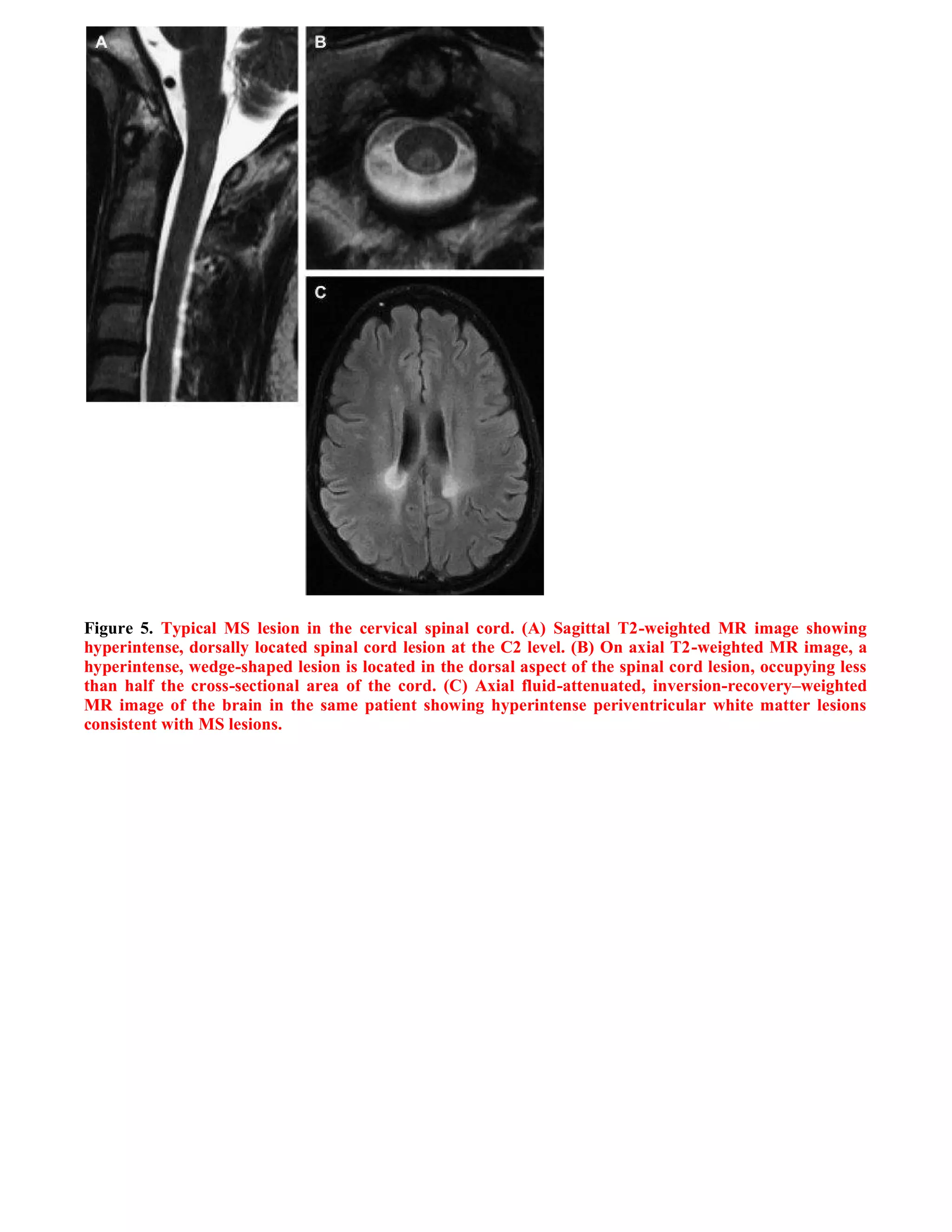 Case record...Spinal multiple sclerosis