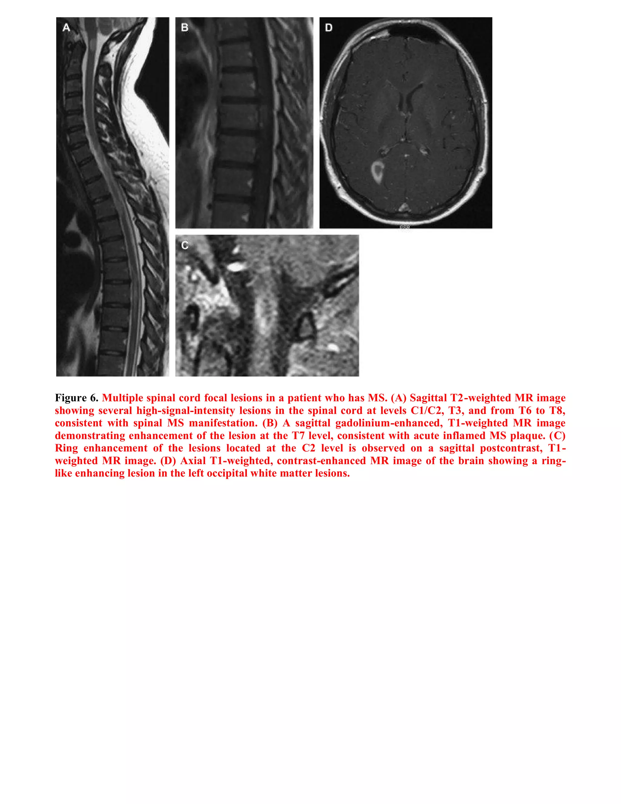 Case record...Spinal multiple sclerosis