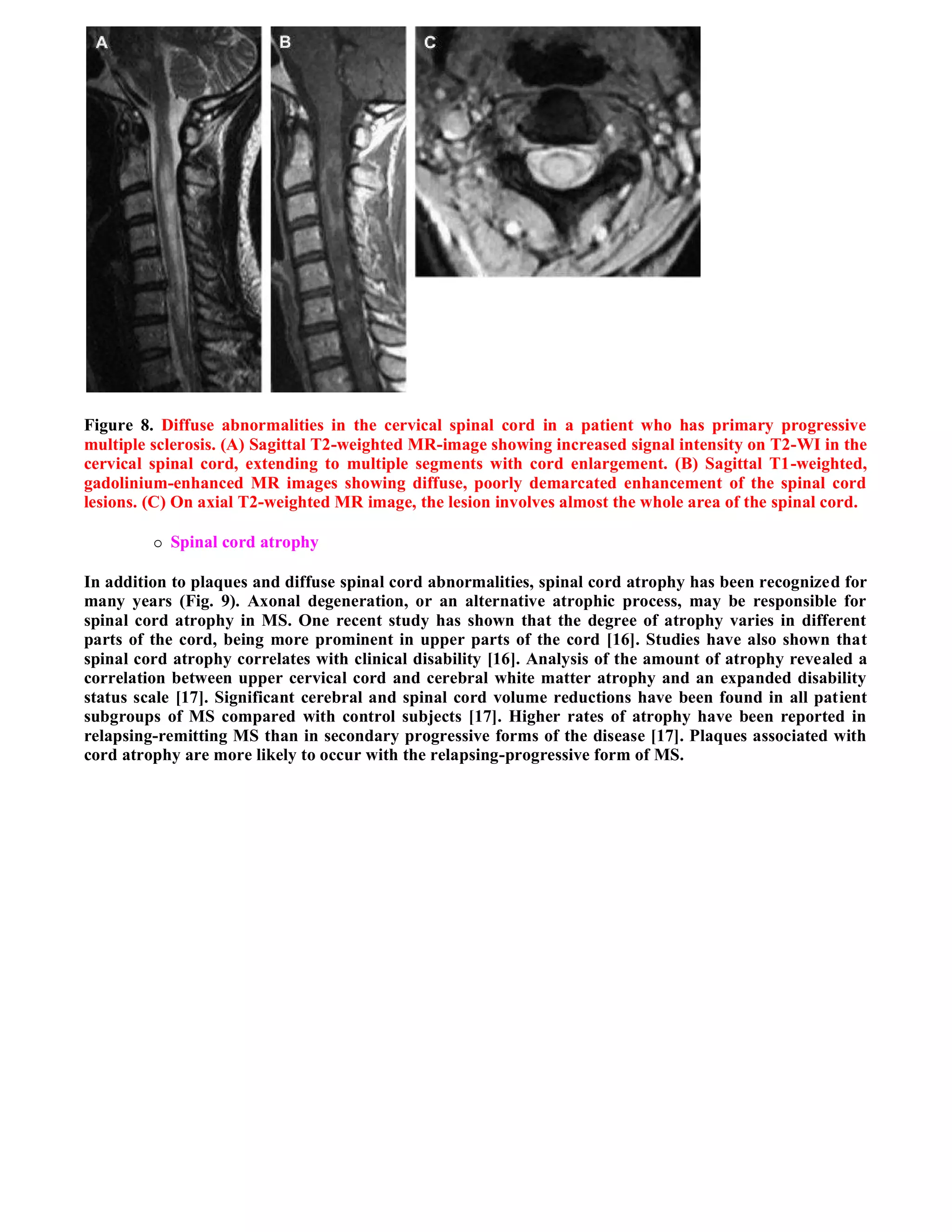 Case record...Spinal multiple sclerosis