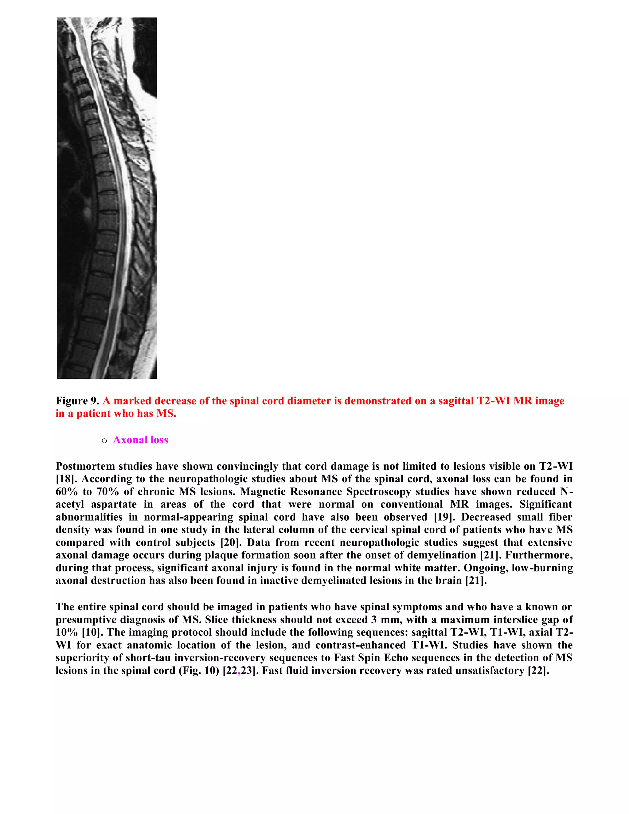Case record...Spinal multiple sclerosis
