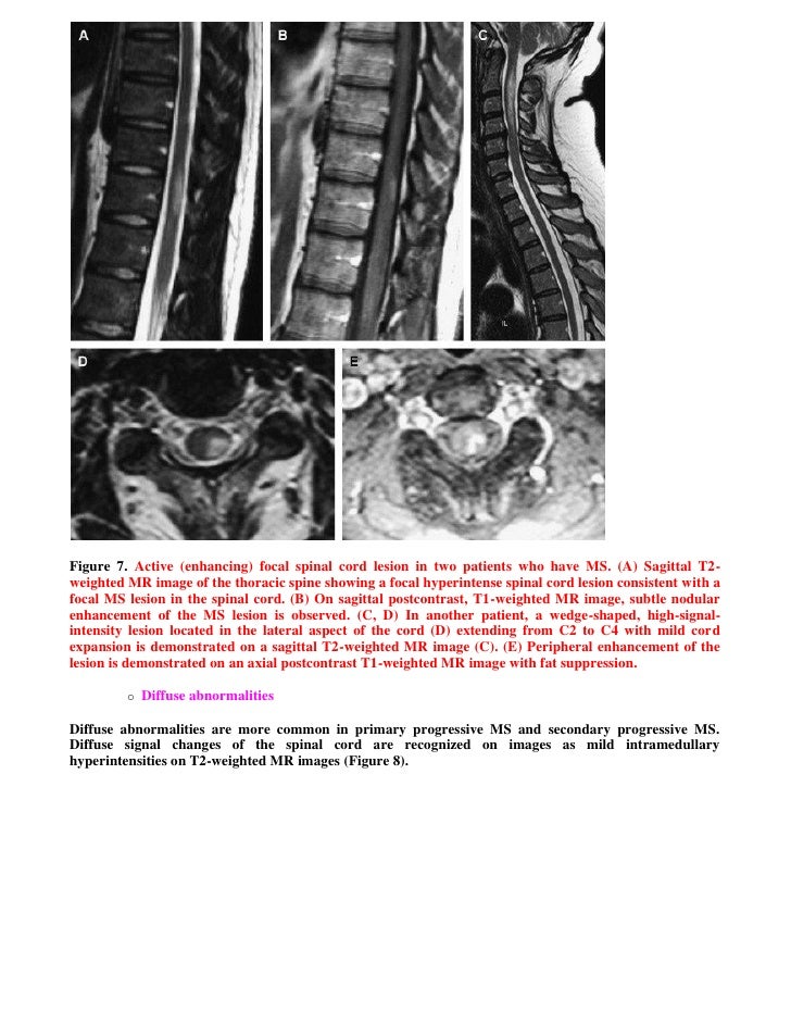 Multiple Ring Shaped Contrast Enhancing Lesions Multiple Ring Shaped Contrast Enhancing Lesions