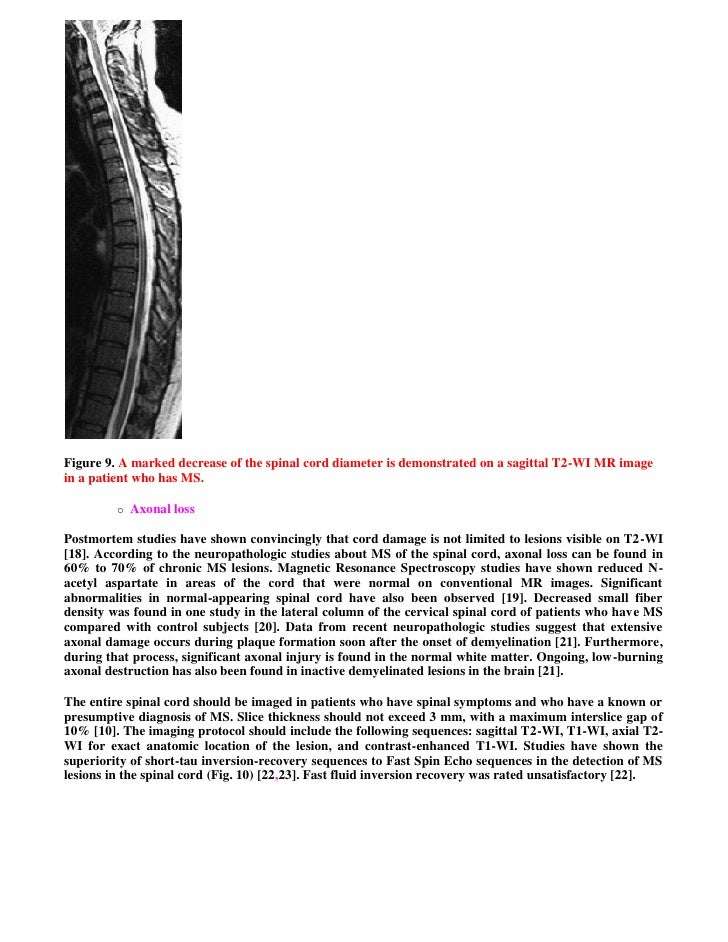 chronic sorrow in multiple sclerosis a case study Chronic sorrow has been described in the caregivers of individuals with myelomeningocele, multiple sclerosis, parkinson's disease, cancer, and premature infants most studies have reported small numbers of fathers for comparison with mothers one unpublished study compared chronic sorrow and. chronic sorrow in multiple sclerosis a case study Chronic sorrow has been described in the caregivers of individuals with myelomeningocele, multiple sclerosis, parkinson's disease, cancer, and premature infants most studies have reported small numbers of fathers for comparison with mothers one unpublished study compared chronic sorrow and.