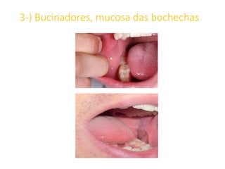 3-) Bucinadores, mucosa das bochechas
 