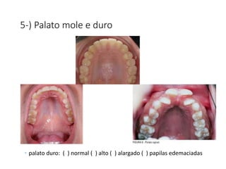 5-) Palato mole e duro
• palato duro: ( ) normal ( ) alto ( ) alargado ( ) papilas edemaciadas
 
