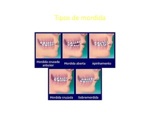 Tipos de mordida
 