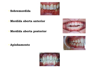 • Sobremordida
• Mordida aberta anterior
• Mordida aberta posterior
• Apinhamento
 