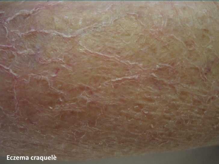 Elementi morfologici di eczema