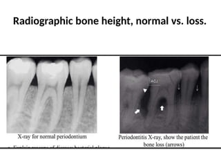 Normal Bone Level Radiograph periodontics discreption criteria for dental students | PPTX