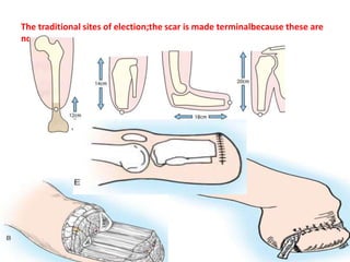 The traditional sites of election;the scar is made terminalbecause these are
not endbearing stumps.
 