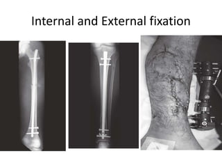Internal and External fixation
 