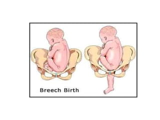 Breech presentation | PDF
