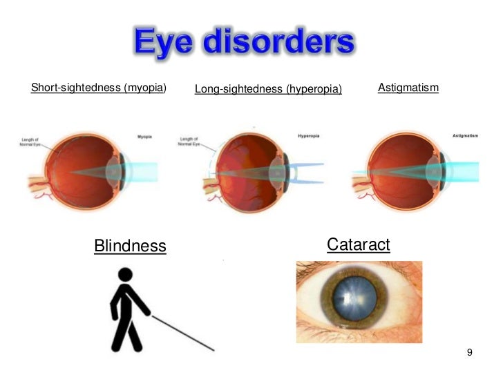 Filip bzik proteins in the lens of the eye
