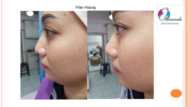 0811 1721 280, Filler hidung di Jakarta Selatan Rinanda Skin Care Ce…