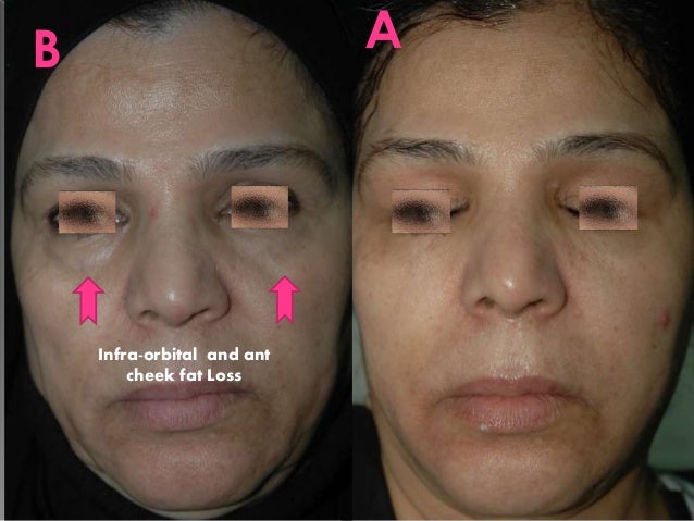 The Art Of Liquid Face Lift Dermal Fillers