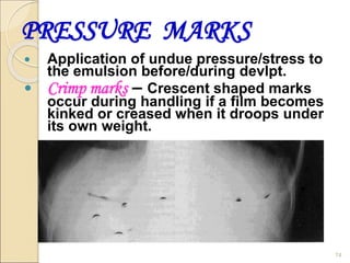 PRESSURE MARKS
 Application of undue pressure/stress to
the emulsion before/during devlpt.
 Crimp marks – Crescent shaped marks
occur during handling if a film becomes
kinked or creased when it droops under
its own weight.
74
 